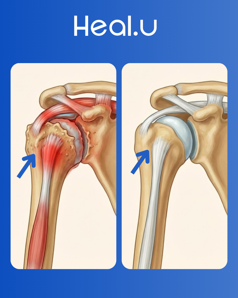 How ShoulderRestore Pro "Triple Therapy" Device Works